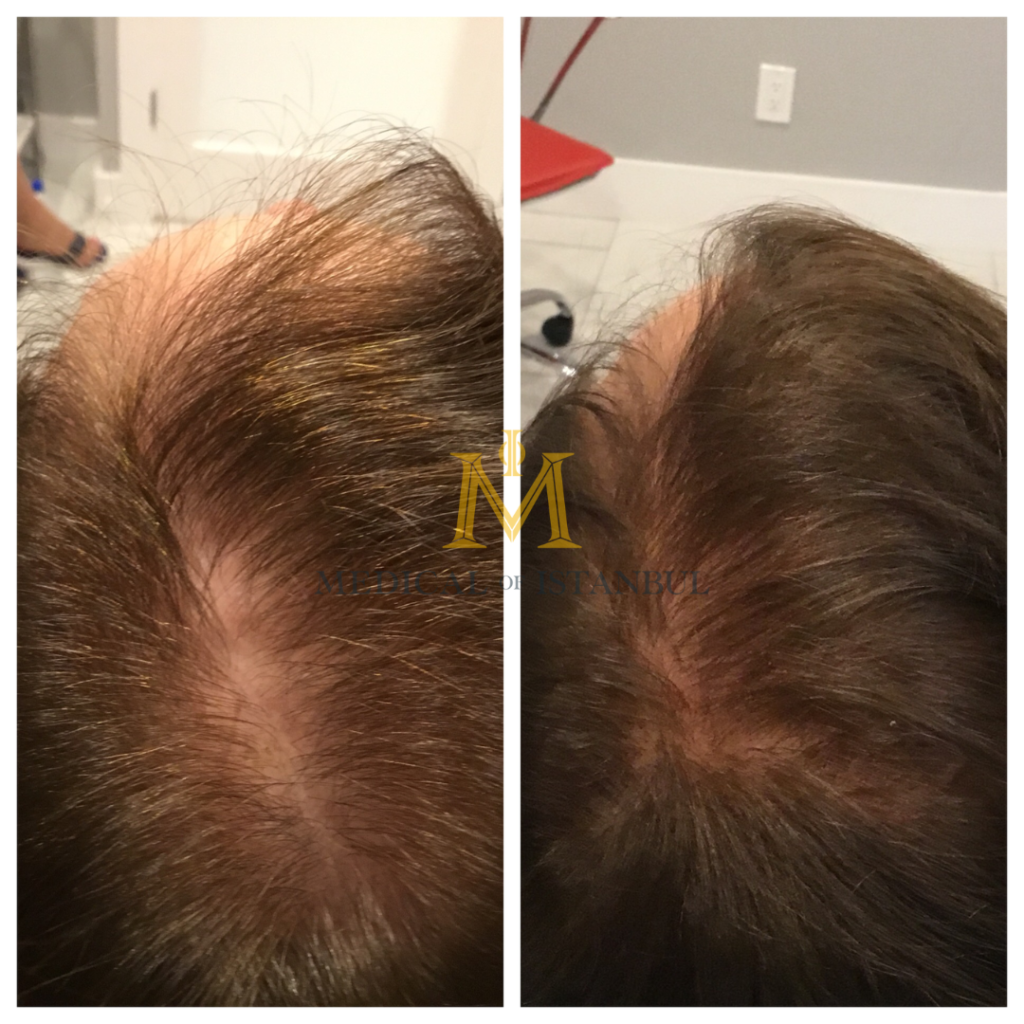 What is hair mesotherapy?