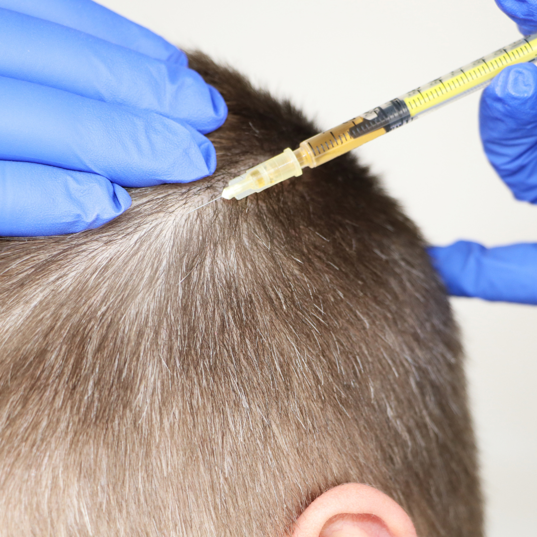 What is hair mesotherapy?