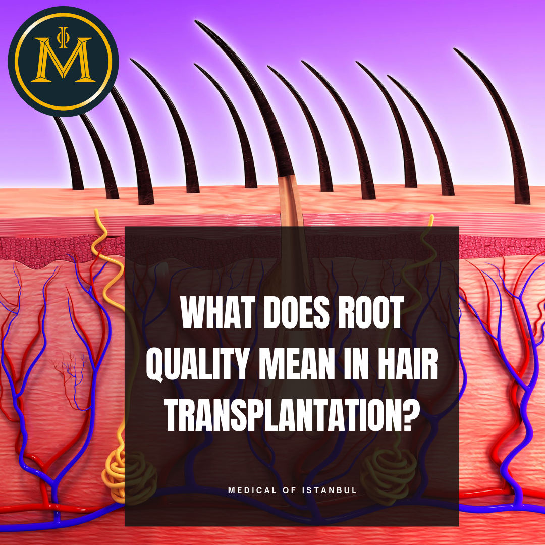 What does root quality mean in hair transplantation?