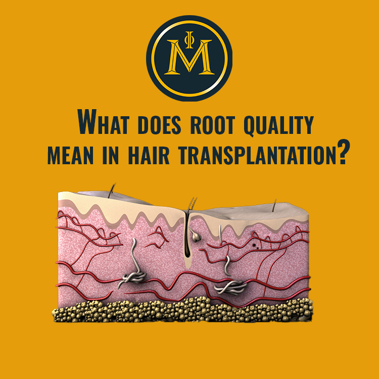 What does root quality mean in hair transplantation?