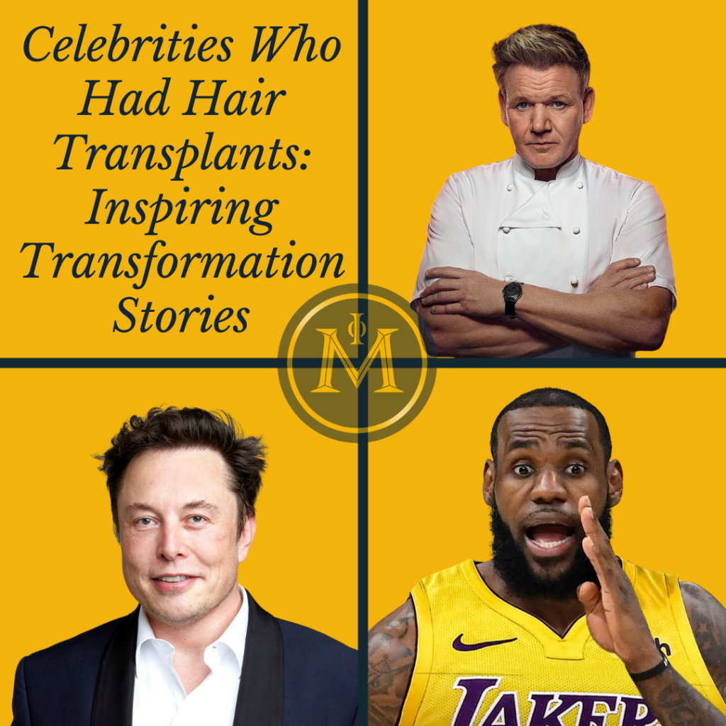 Celebrities Who Had Hair Transplants: Inspiring Transformation Stories