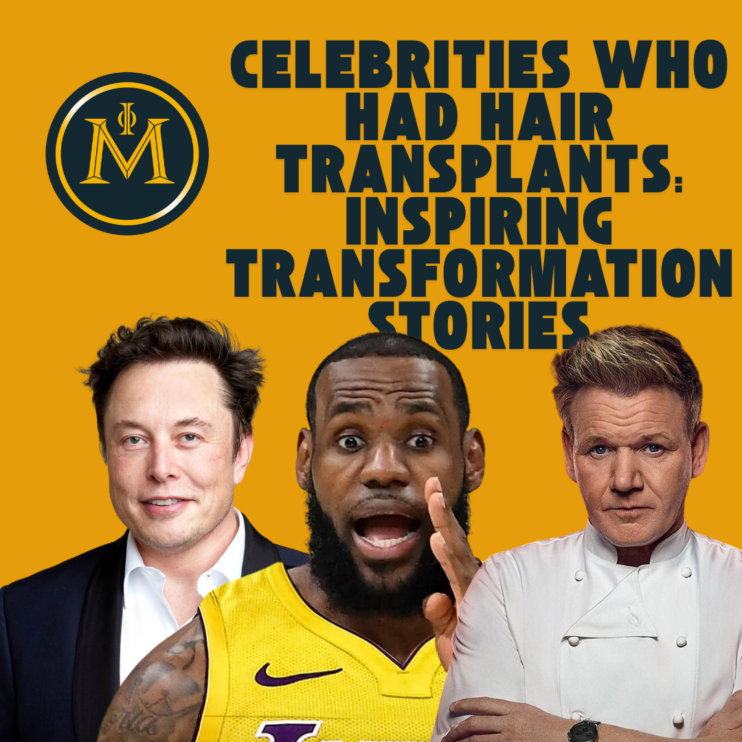 Celebrities Who Had Hair Transplants: Inspiring Transformation Stories