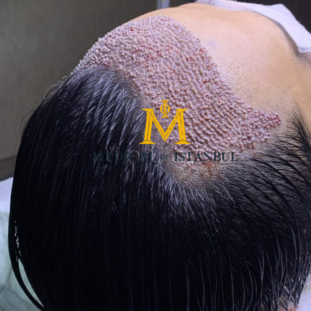 Hair Transplant Recovery Tips: Dos and Don’ts for Best Results