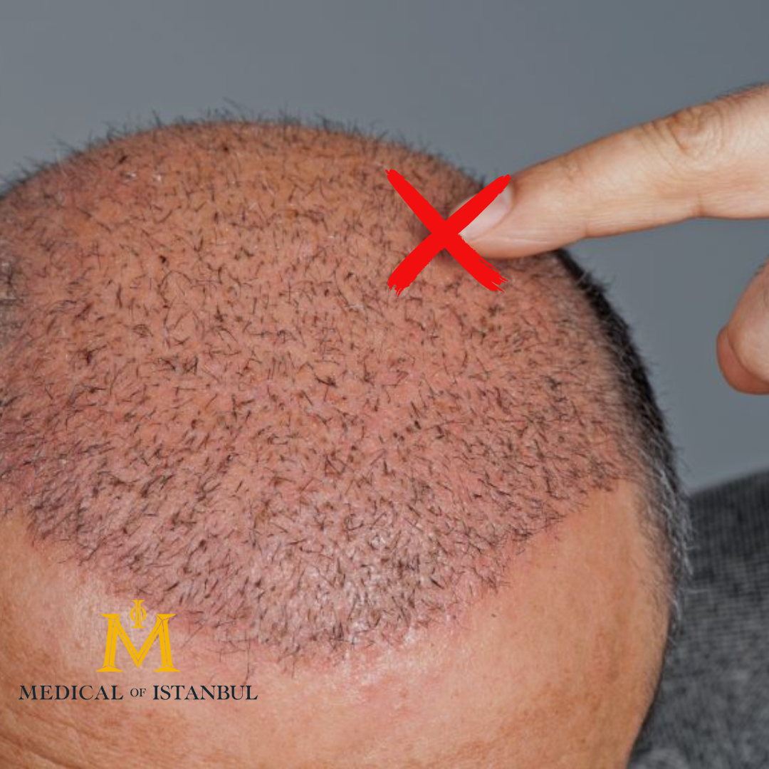 Hair Transplant Recovery Tips: Dos and Don’ts for Best Results