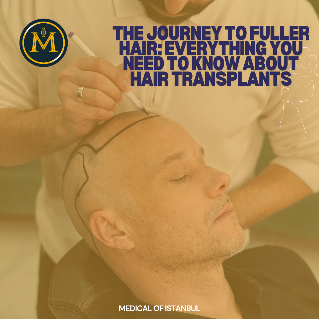 The Journey to Fuller Hair: Everything You Need to Know About Hair Transplants