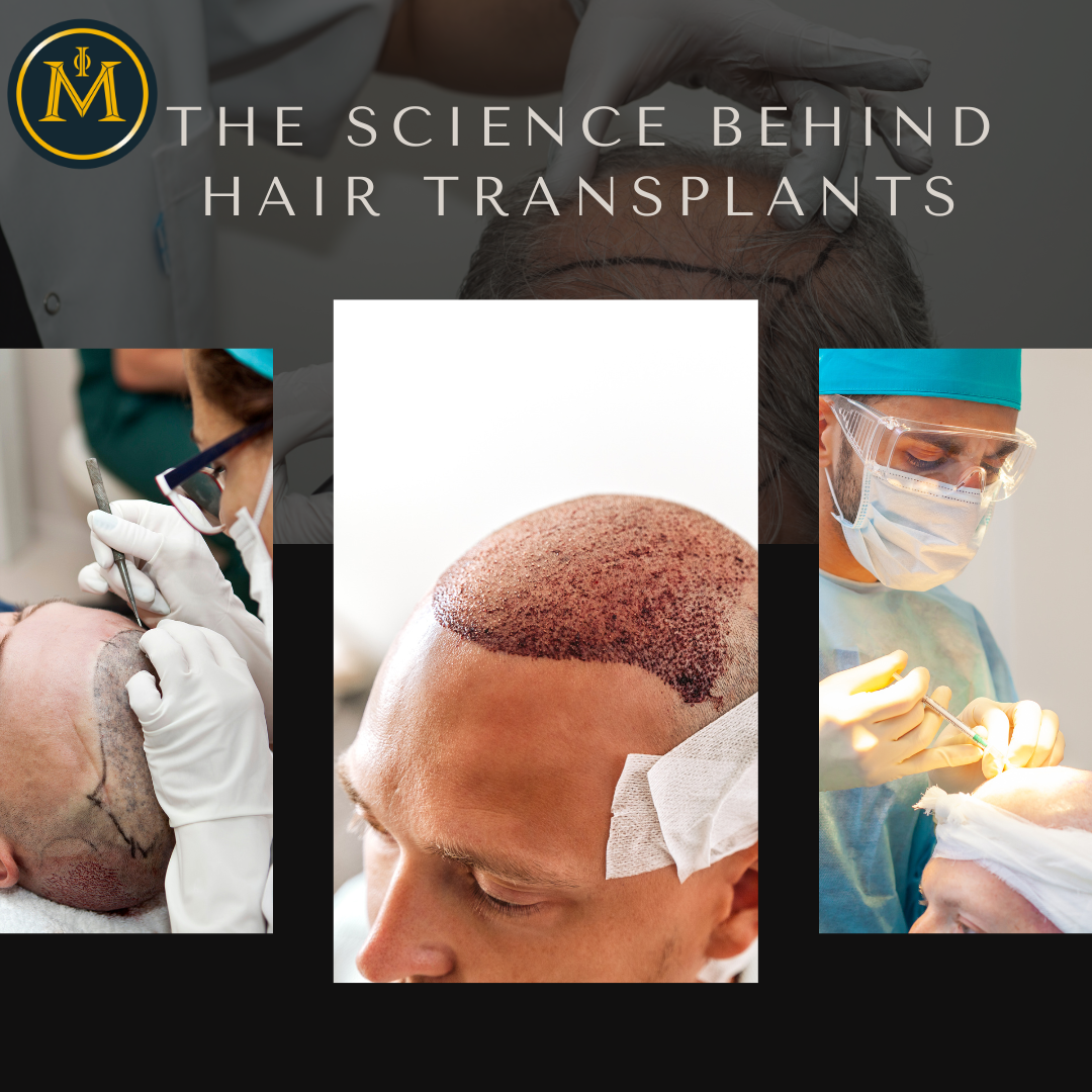 The Science Behind Hair Transplants: How It Works and Why It Lasts