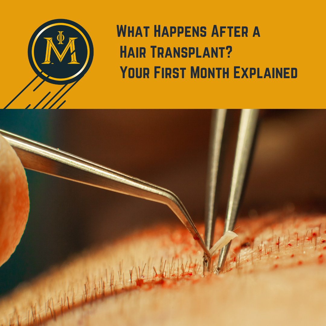 What Happens After a Hair Transplant? Your First Month Explained