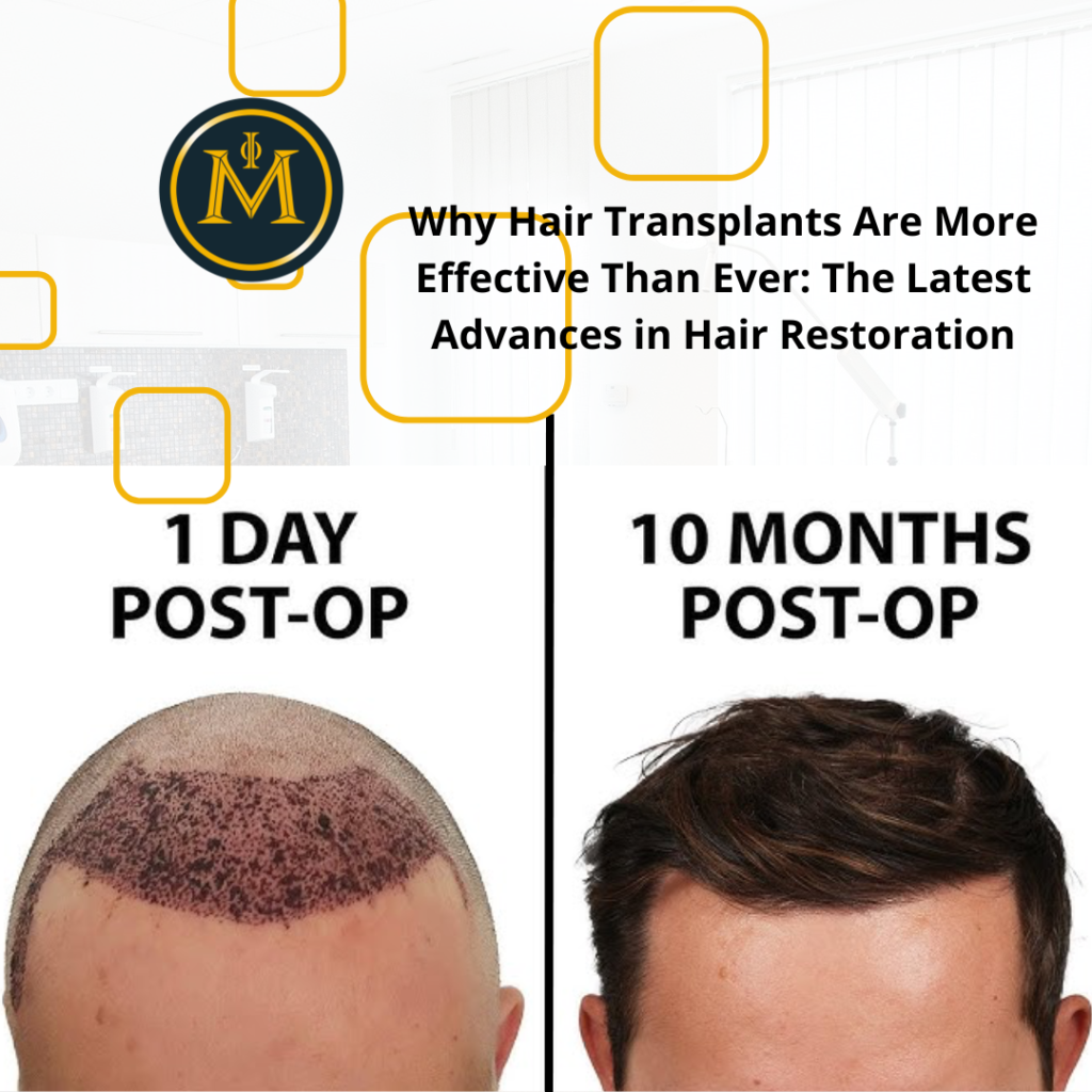 Why Hair Transplants Are More Effective Than Ever: The Latest Advances in Hair Restoration