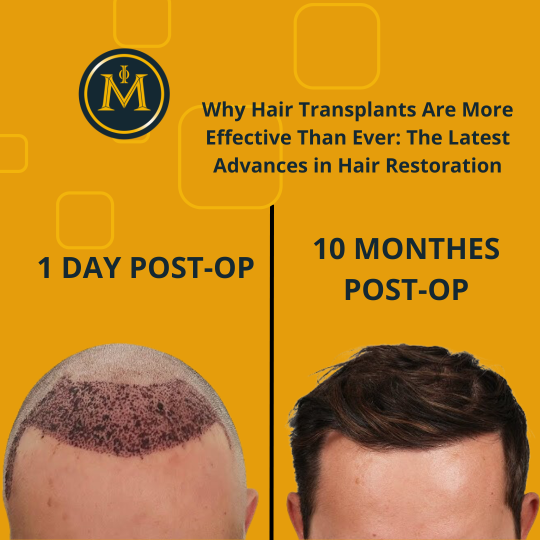 Why Hair Transplants Are More Effective Than Ever: The Latest Advances in Hair Restoration