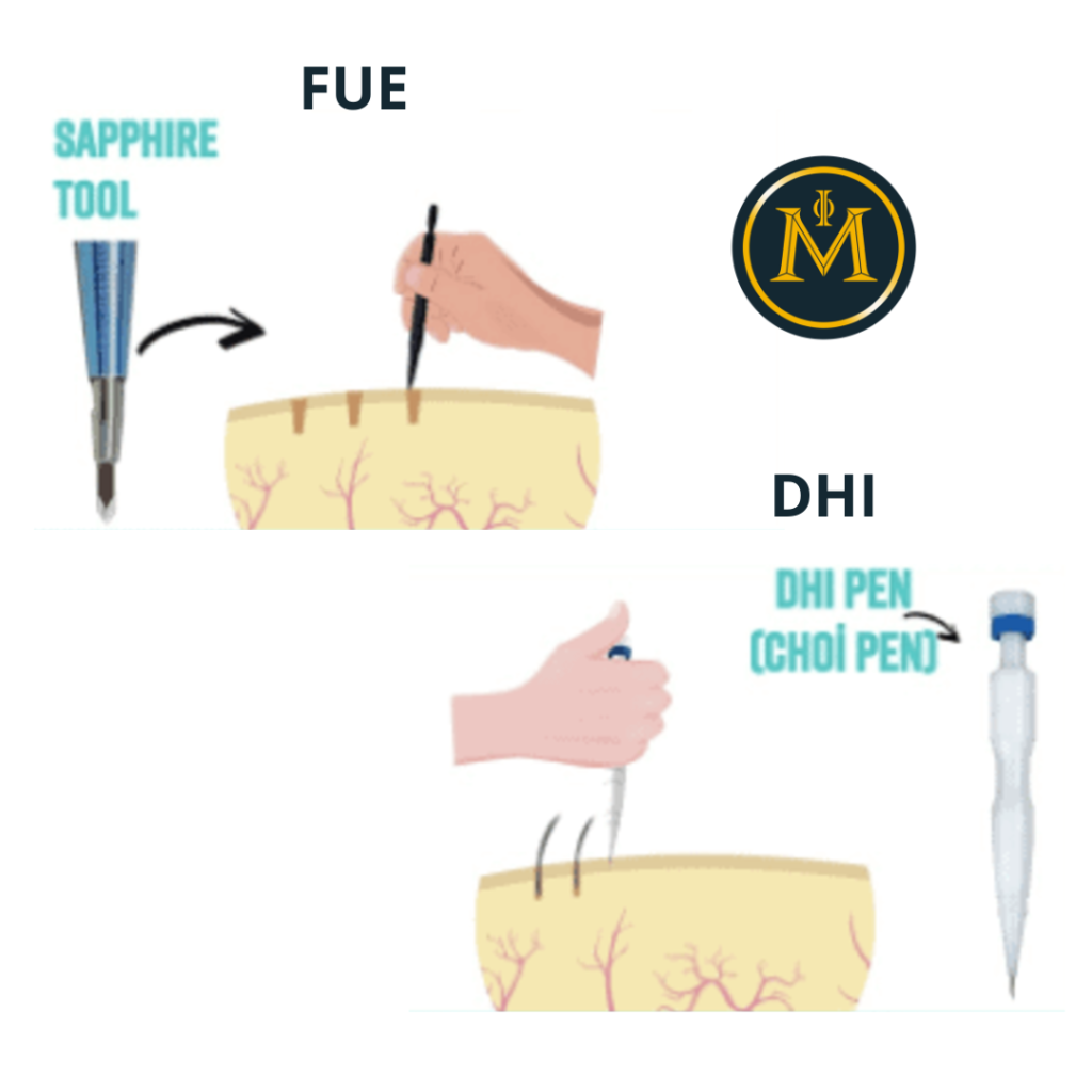 Why Hair Transplants Are More Effective Than Ever The Latest Advances in Hair Restoration