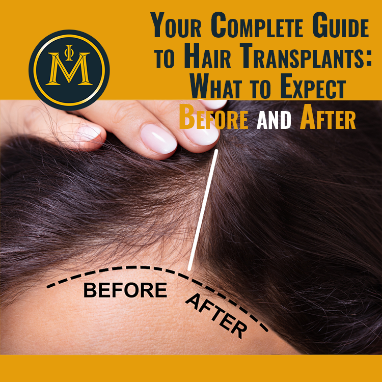 Your Complete Guide to Hair Transplants: What to Expect Before and After