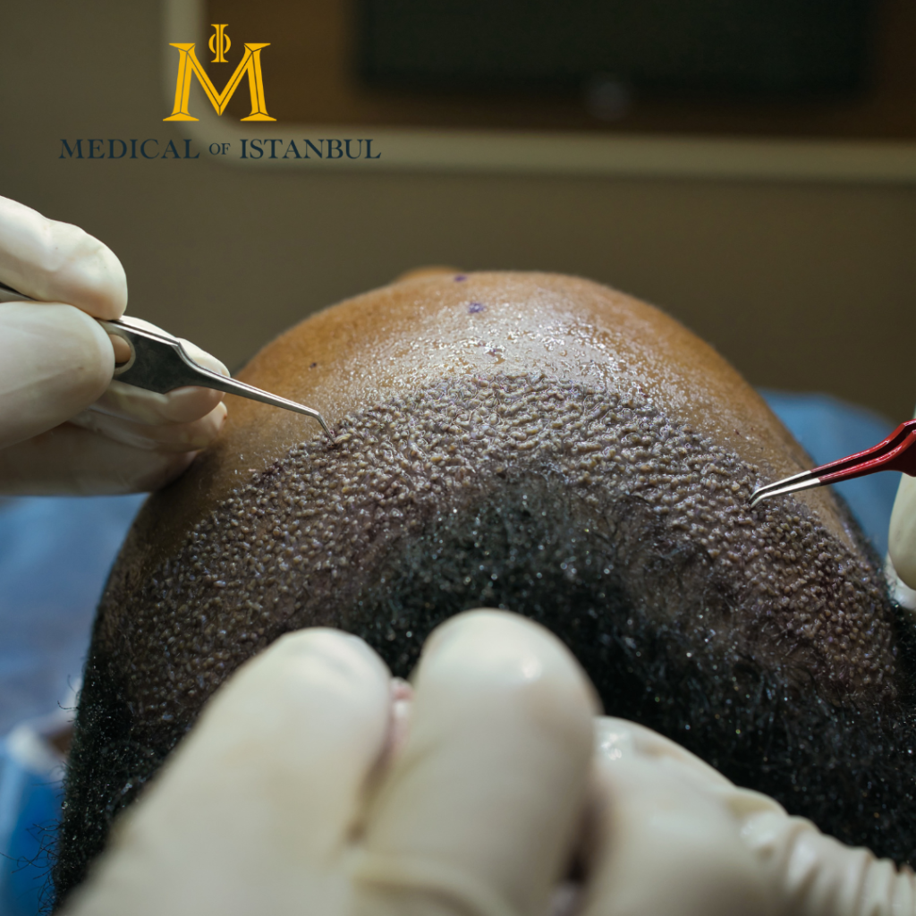 Your Complete Guide to Hair Transplants: What to Expect Before and After