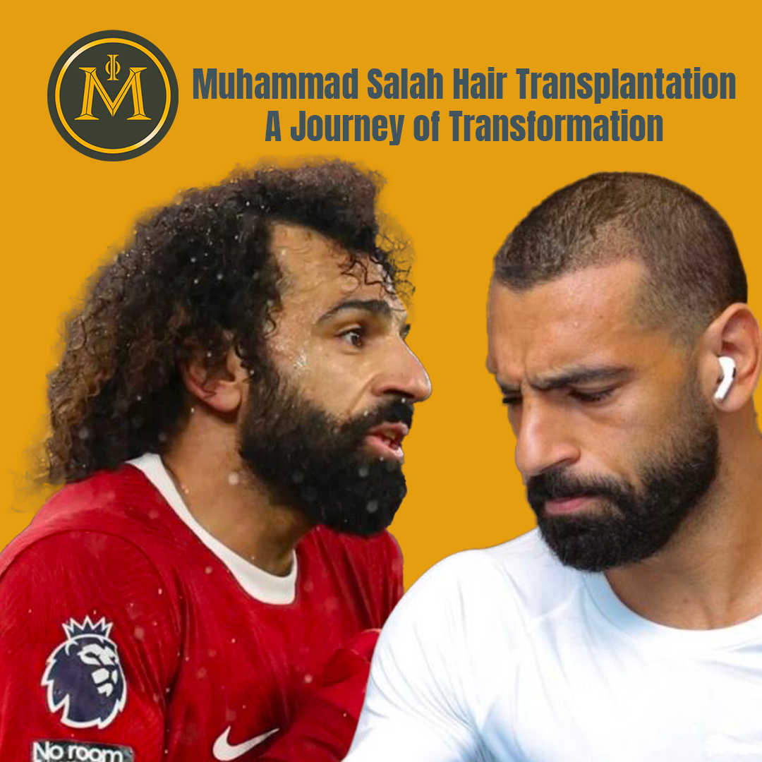 Muhammad Salah Hair Transplantation, A Journey of Transformation