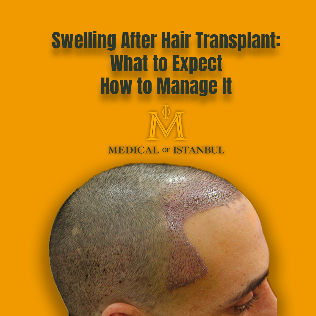 Swelling After Hair Transplant: What to Expect and How to Manage It