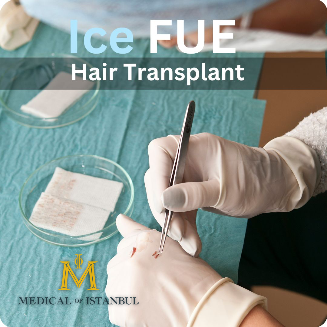 Ice FUE Hair Transplant