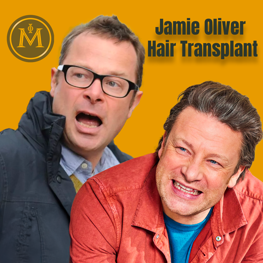 Jamie Oliver Hair Transplant