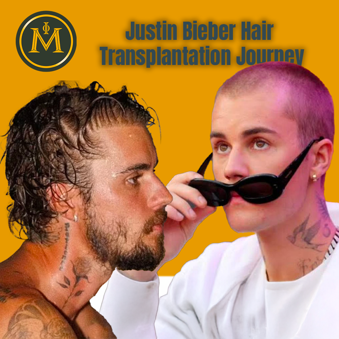 Justin Bieber Hair Transplantation Journey