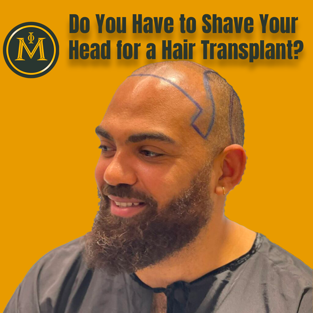 Do You Have to Shave Your Head for a Hair Transplant?