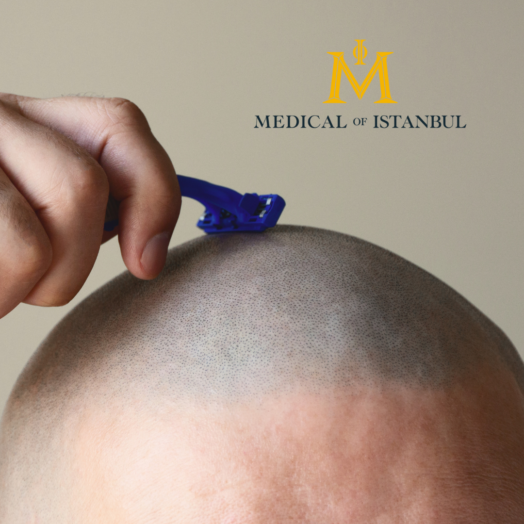 Do You Have to Shave Your Head for a Hair Transplant?