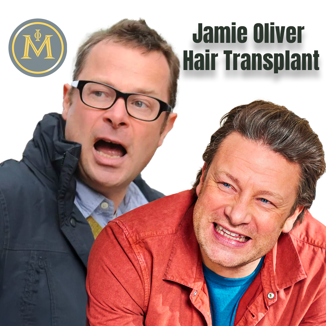 Jamie Oliver Hair Transplant