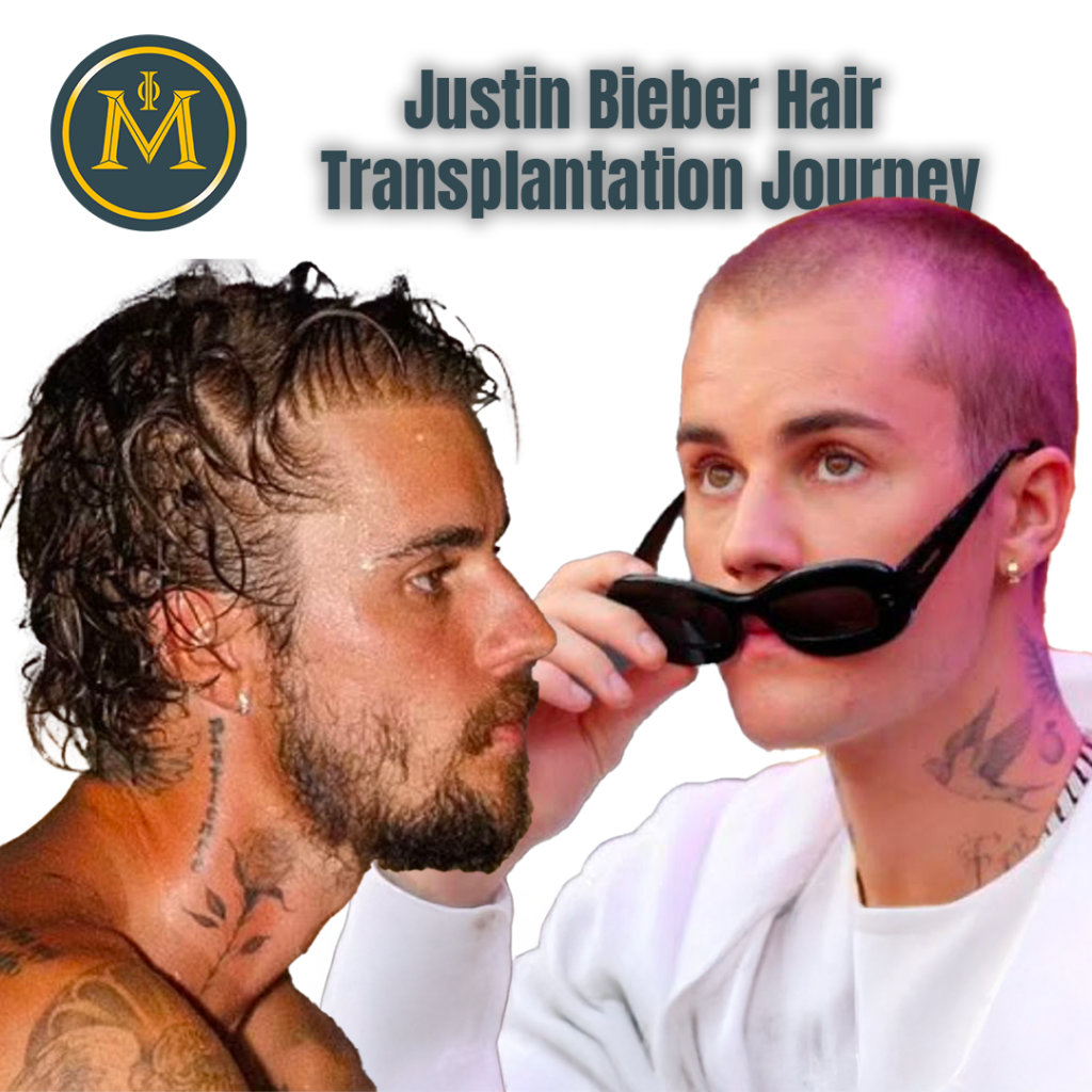 Justin Bieber Hair Transplantation Journey