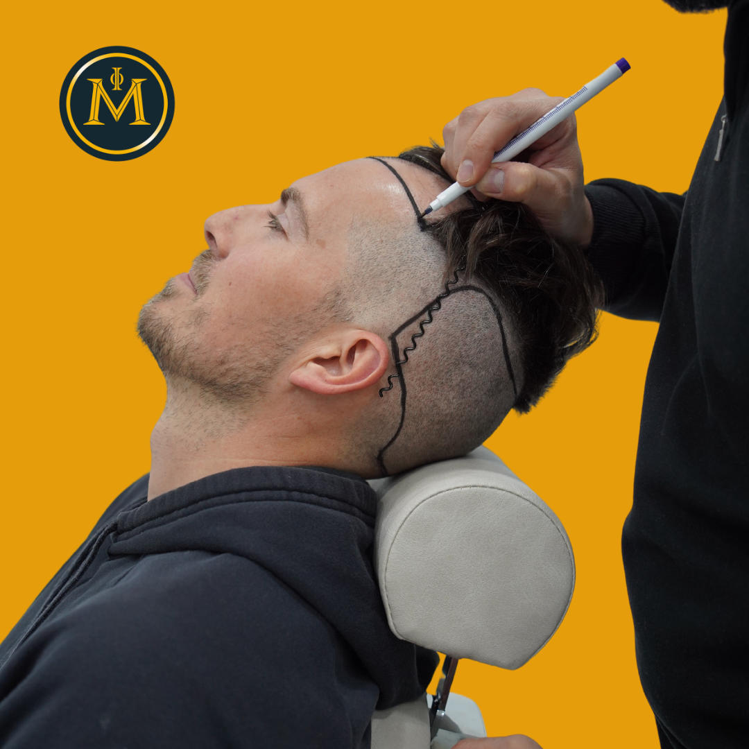 What to Consider Before Getting a Hair Transplant?