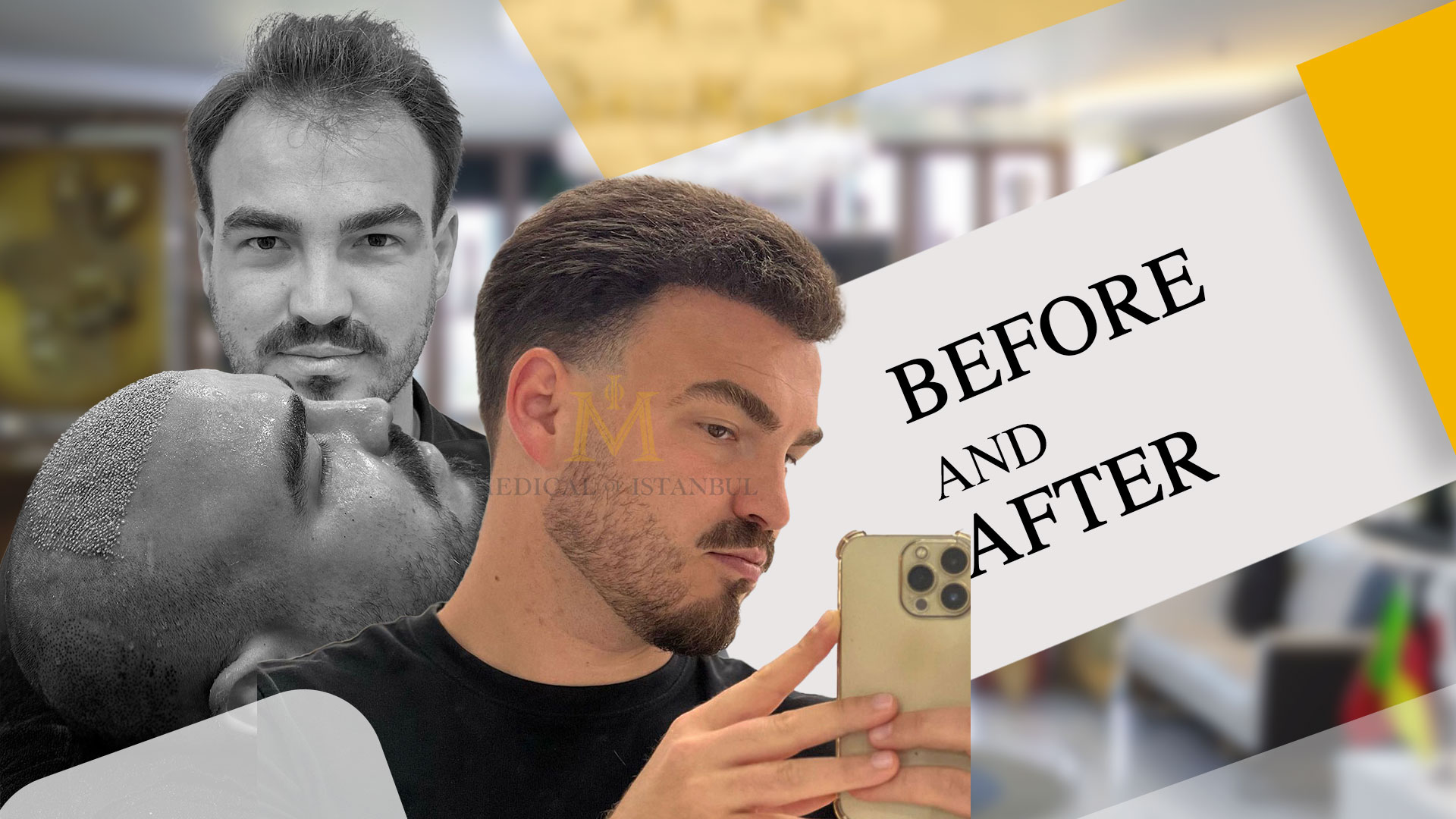 James – Hair Transplant Journey