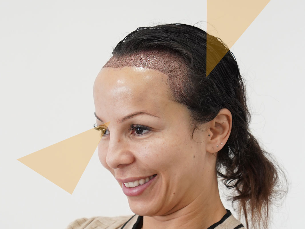 Women Hair Transplant