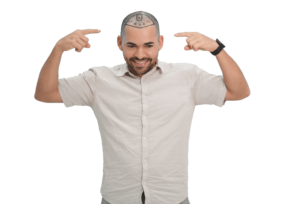 Before hair Trasnaplant