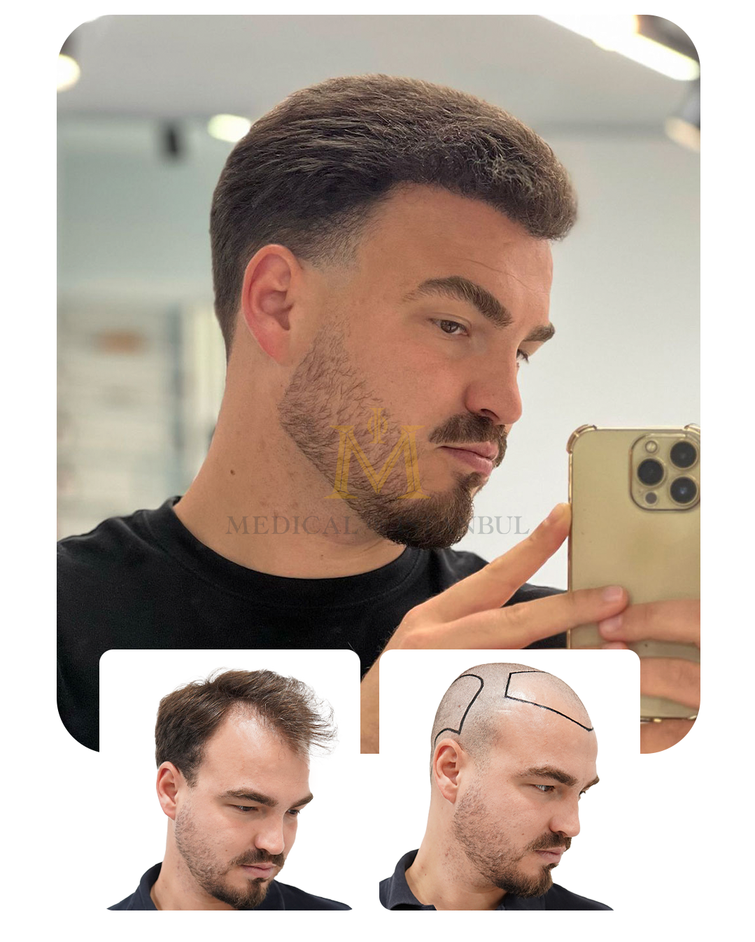 Dinis BEfore and After