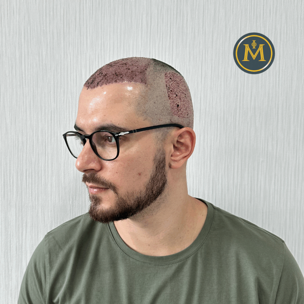 What Is Hair Transplantation? A Beginner’s Guide