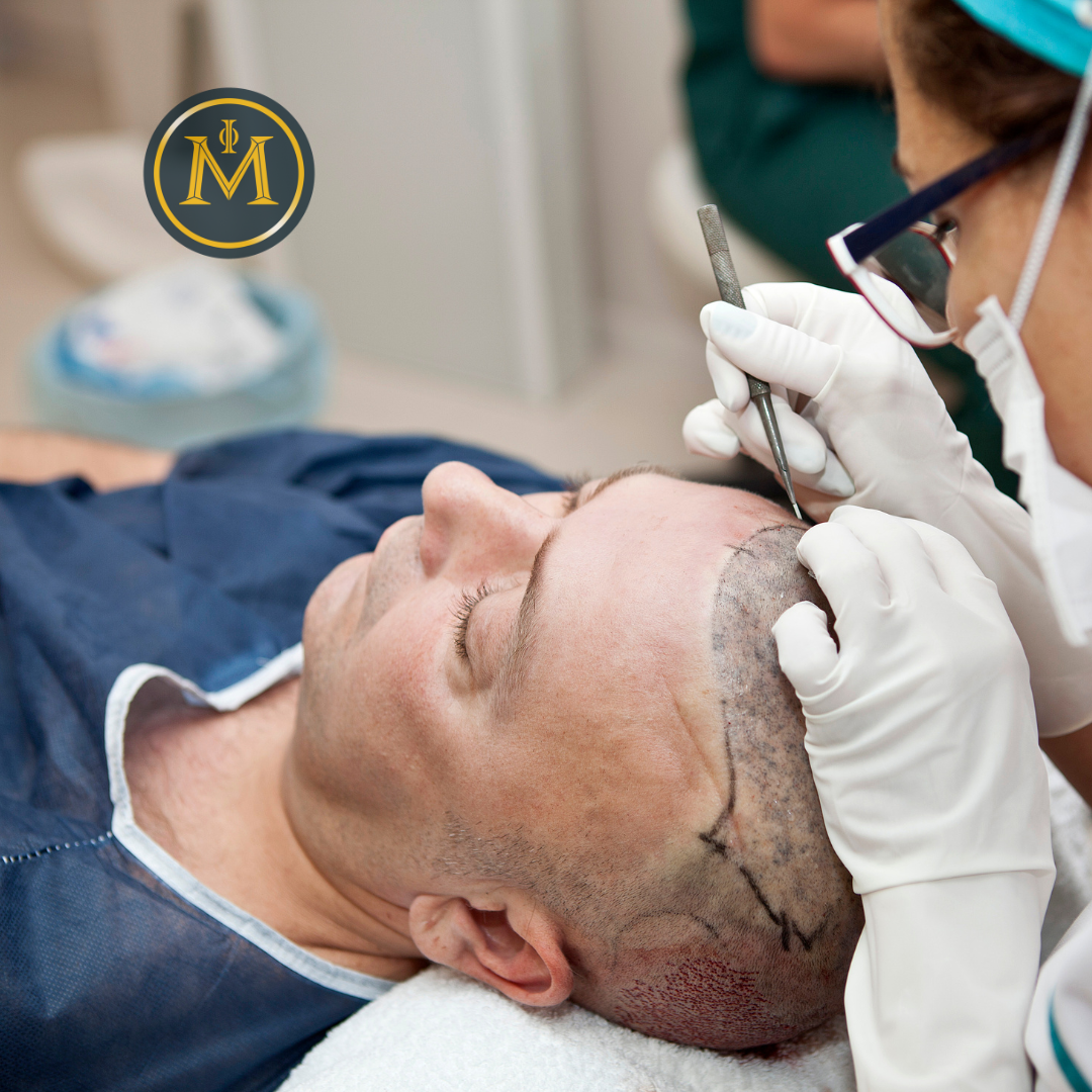 What Is Hair Transplantation? A Beginner’s Guide
