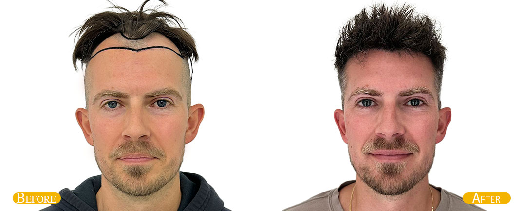 Before and After Hair Transplant