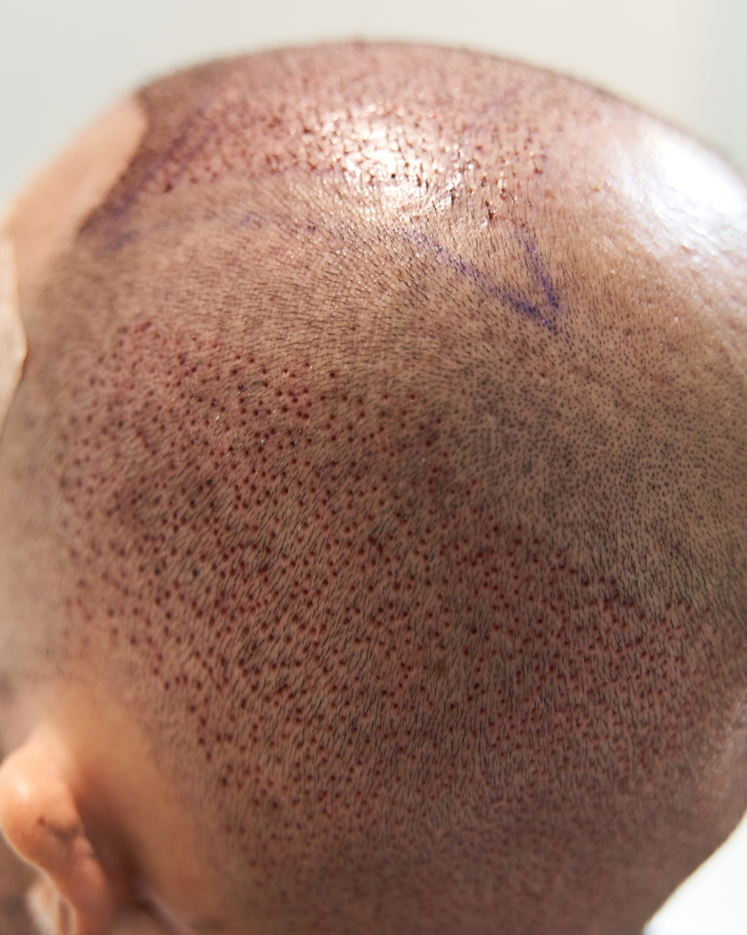 Understanding Hair Transplants
