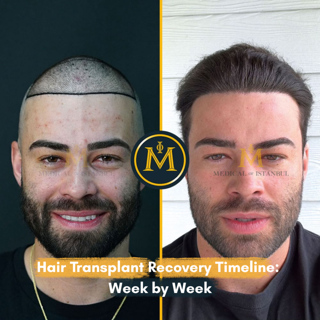 Hair Transplant Recovery Timeline: Week by Week