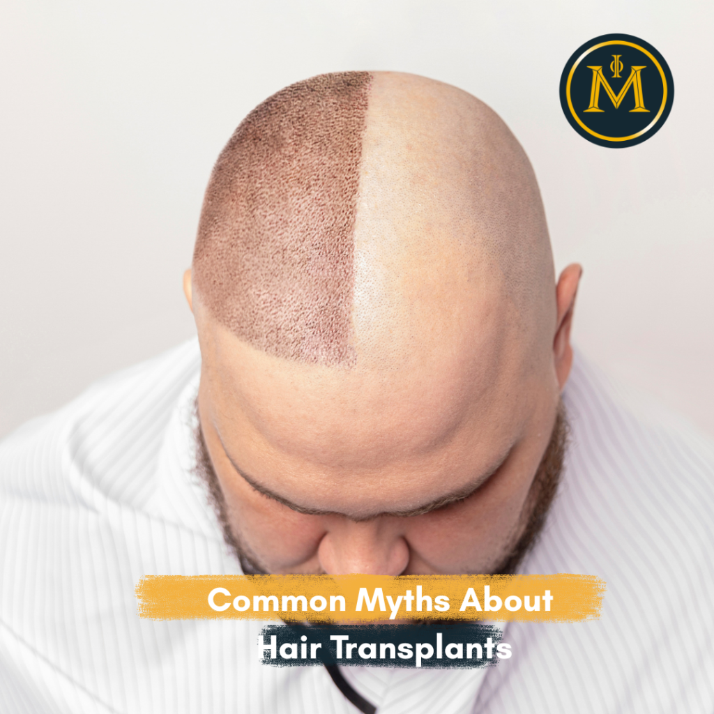 Common Myths About Hair Transplants, Debunked