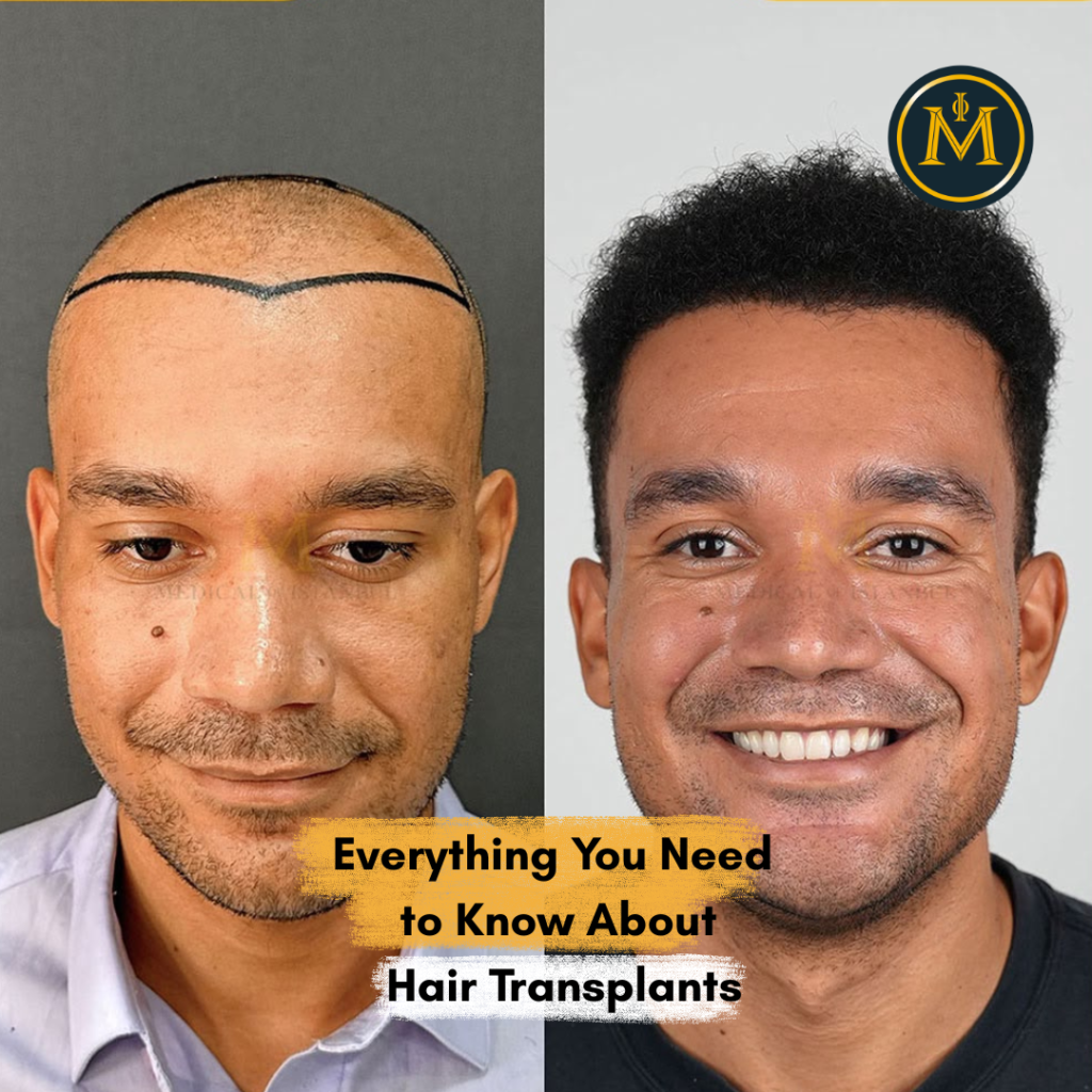 Life After a Hair Transplant: What to Expect Month by Month