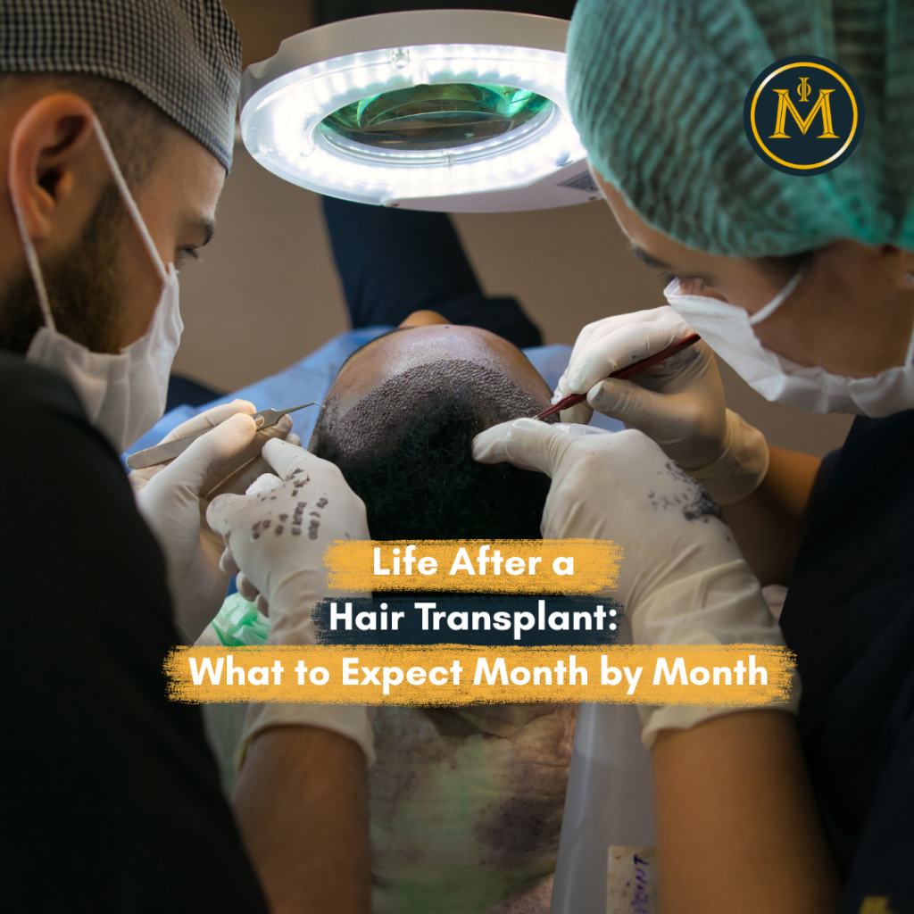 Life After a Hair Transplant: What to Expect Month by Month