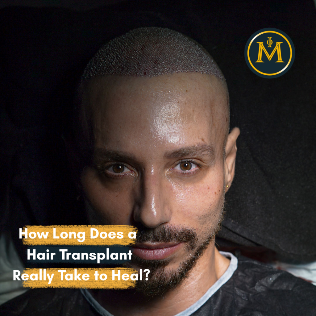 How Long Does a Hair Transplant Really Take to Heal?