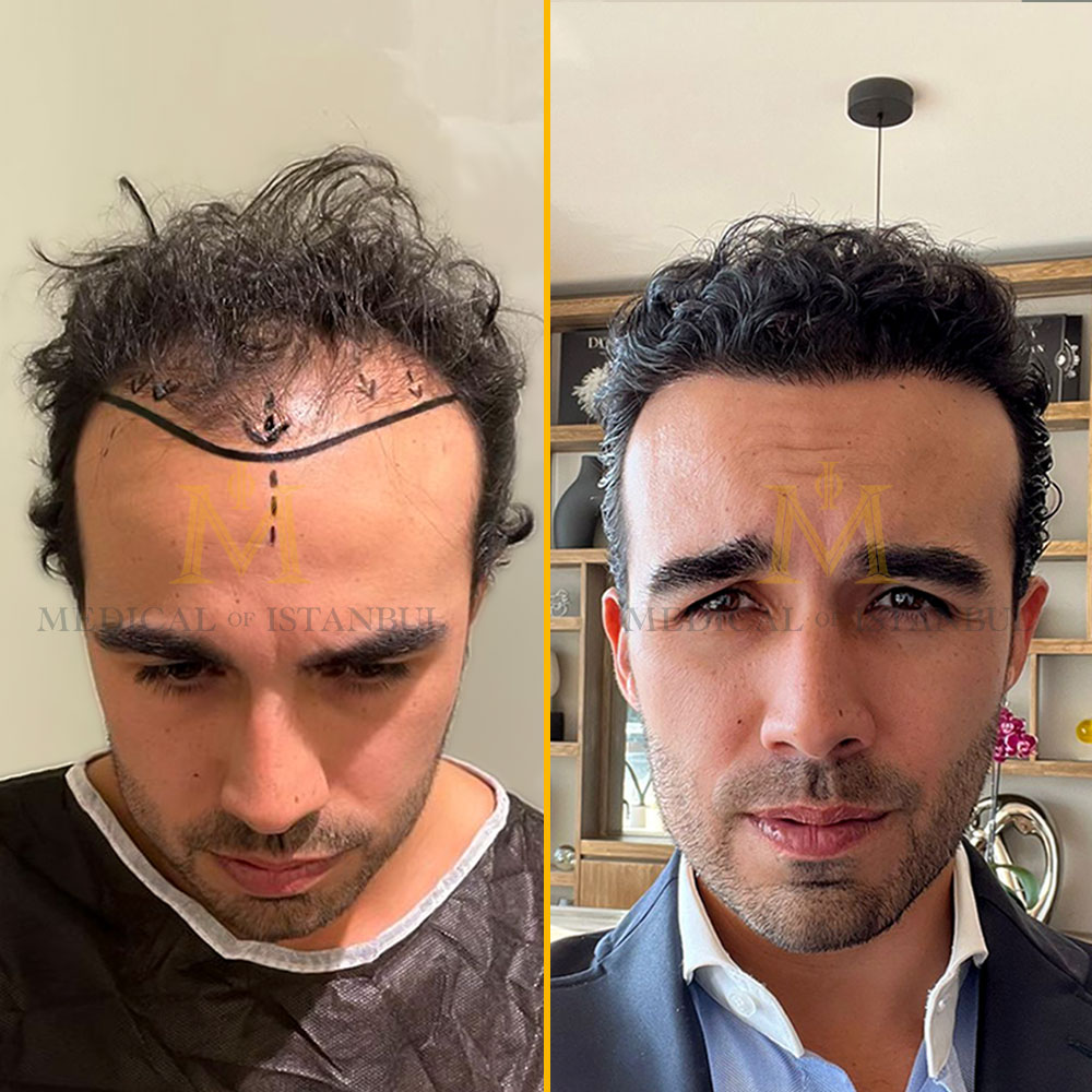 Carlos Hair Transplnat