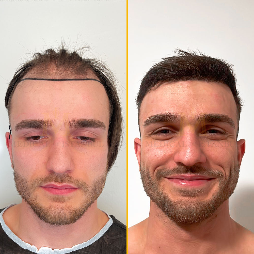 Scot-before-and-After
